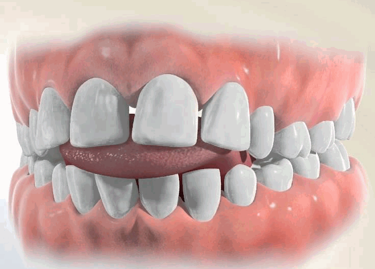 Soms verplaatst de tong zich tijdens het slikken naar voren. Dit heet een tongpers.